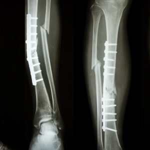 a new type of bone graft to mend broken bones