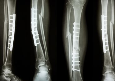 a new type of bone graft to mend broken bones