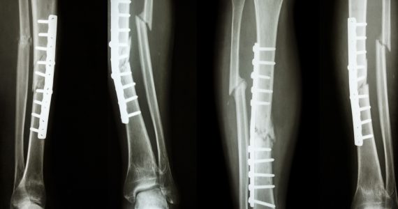 a new type of bone graft to mend broken bones