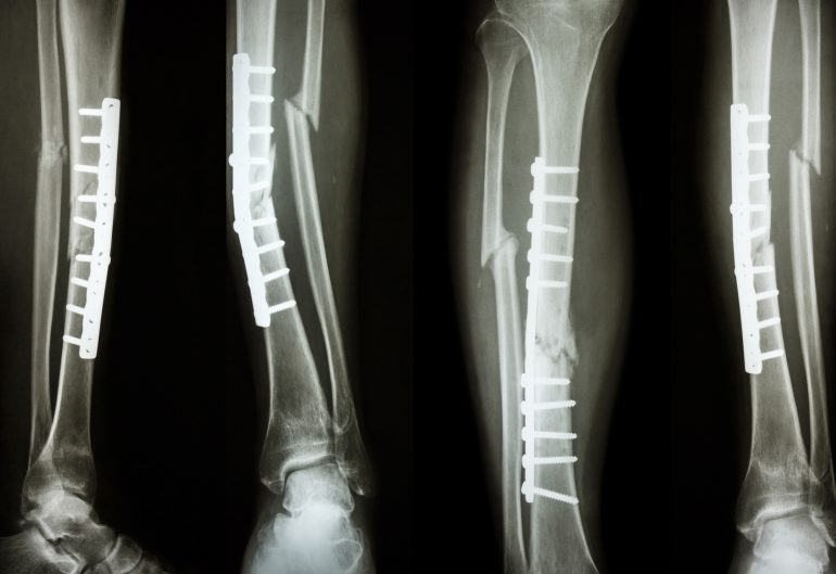 a new type of bone graft to mend broken bones