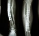 a new type of bone graft to mend broken bones